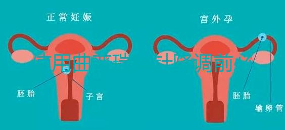 使用曲普瑞林針降調前必看：3大作用對比5大副作用