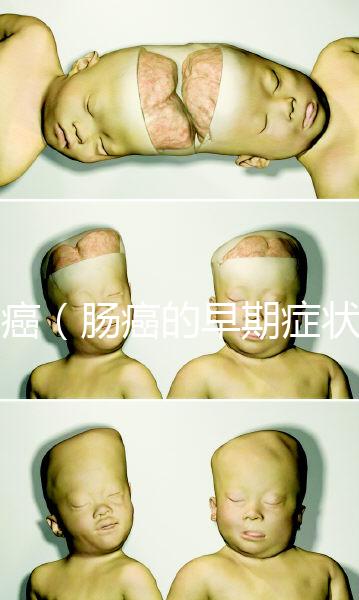 腸癌（腸癌的早期癥狀有哪些）