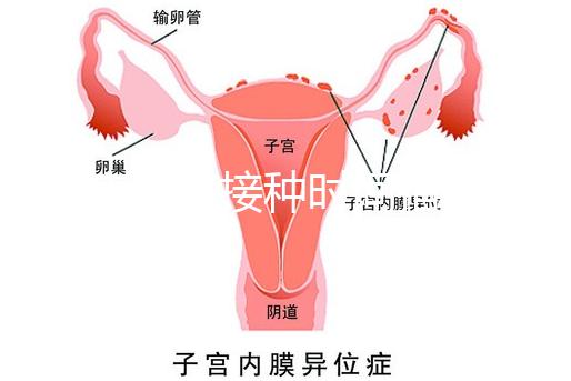 麻疹疫苗接種時間指南，初種年齡最好不要晚于這個月齡